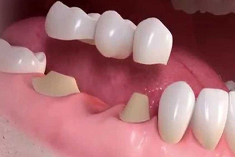 Artificial Teeth, Dental Crowns & Bridges