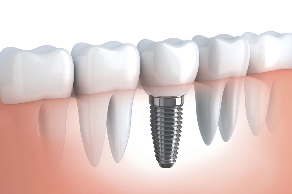 dental implant
