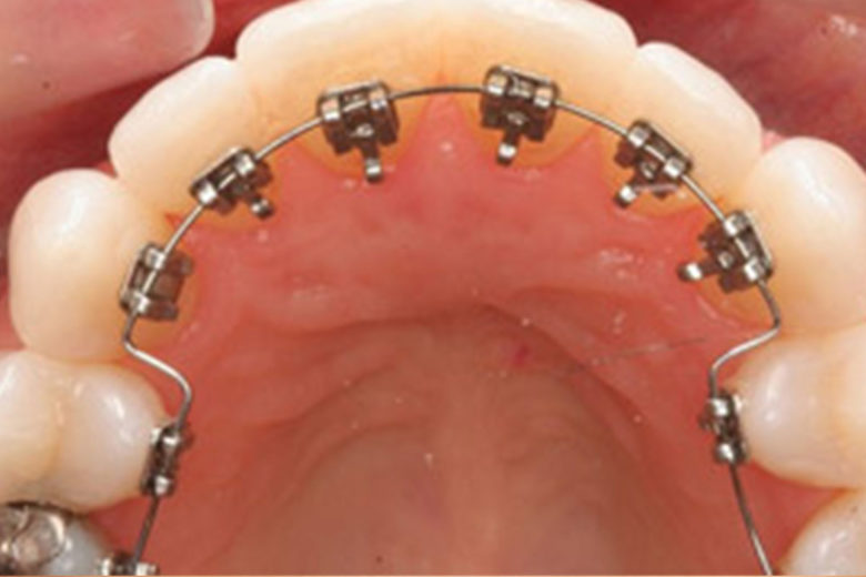 Invisible braces in indore