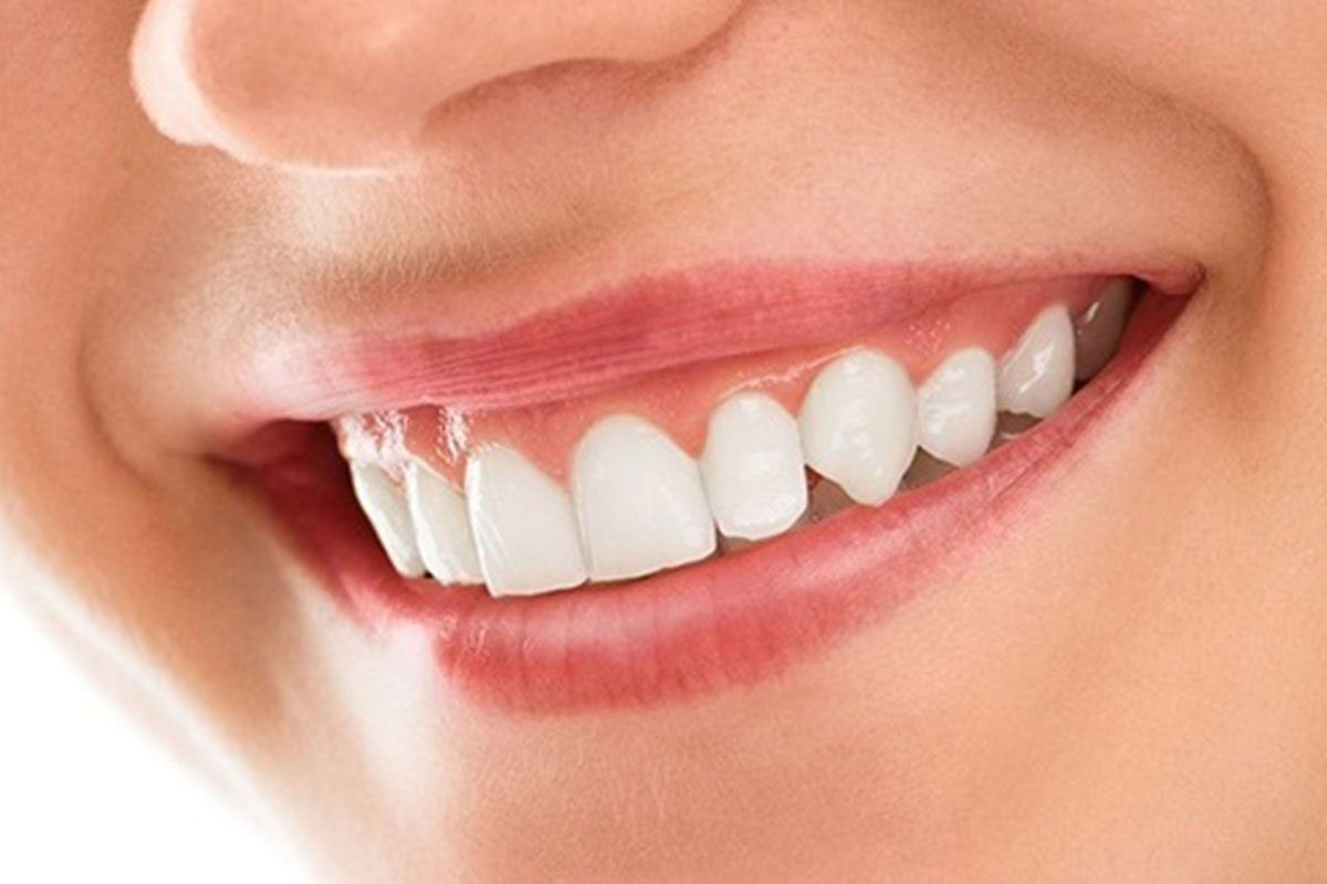 Smile Makeover Treatment - Teeth & Braces Clinic Indore