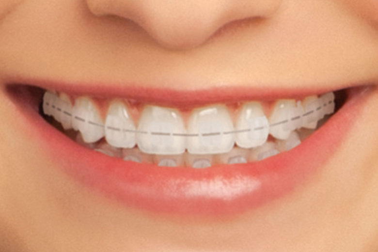 clear braces dentist in indore
