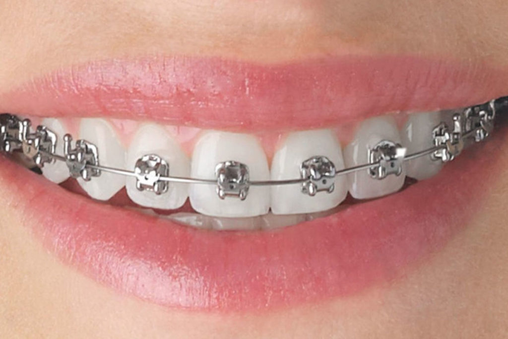 metal braces in indore