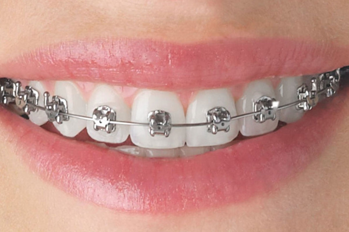 Metallic Braces - Teeth & Braces Clinic - Indore