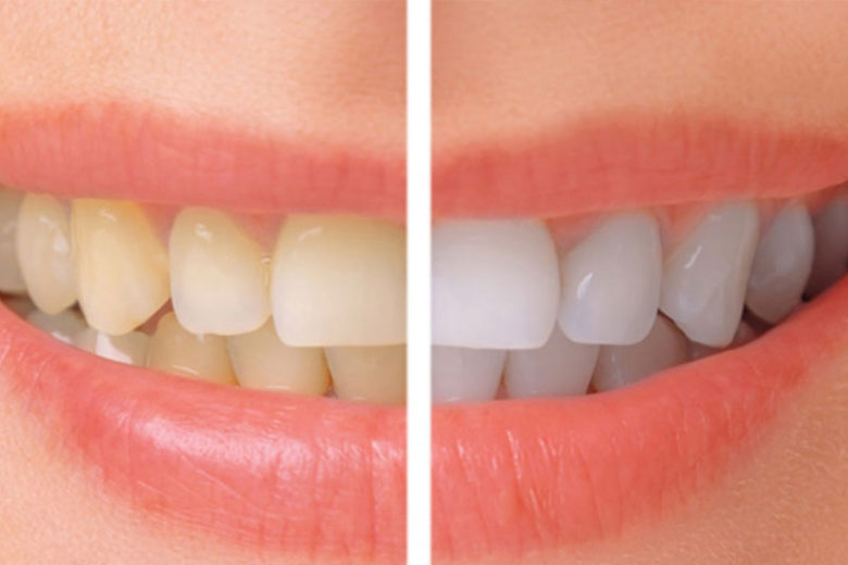 Teeth Whitening