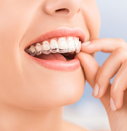 Best invisible braces dentist indore