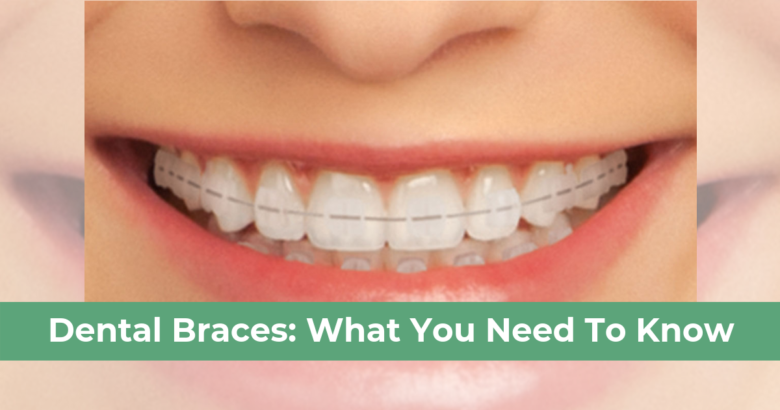Dental Braces What You Need To Know