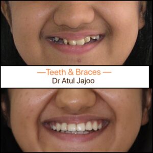 Crooked Teeth: Causes, Health Risks & Treatment Options Beyond Braces