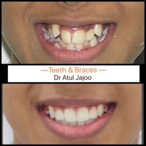 Crooked Teeth: Causes, Health Risks & Treatment Options Beyond Braces