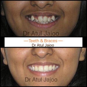 Crooked Teeth: Causes, Health Risks & Treatment Options Beyond Braces