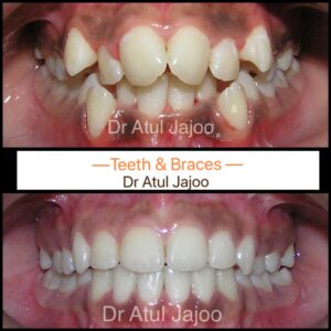 Crooked Teeth: Causes, Health Risks & Treatment Options Beyond Braces