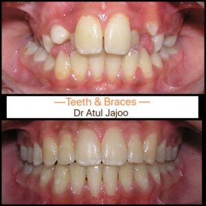 Crooked Teeth: Causes, Health Risks & Treatment Options Beyond Braces