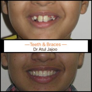 Crooked Teeth: Causes, Health Risks & Treatment Options Beyond Braces