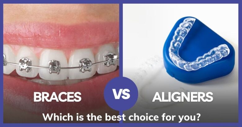 Braces vs Aligners, which is the best choice for you