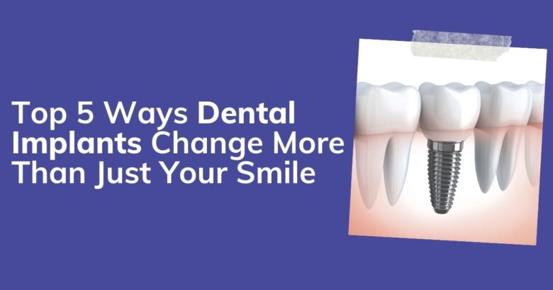 Top 5 Ways Dental Implants Change More Than Just Your Smile