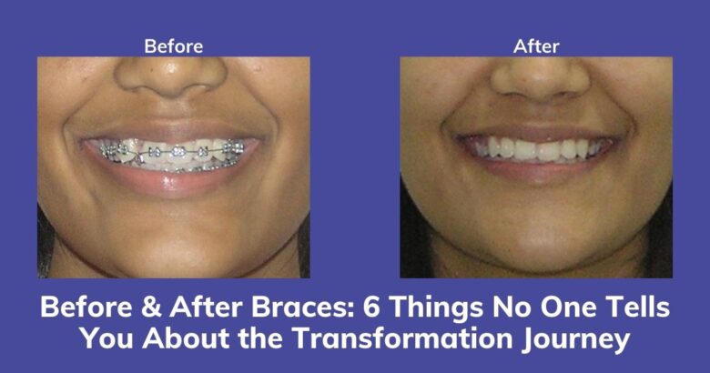 Before and After Braces