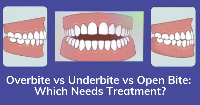 Overbite vs Underbite vs Open Bite: Which Needs Treatment