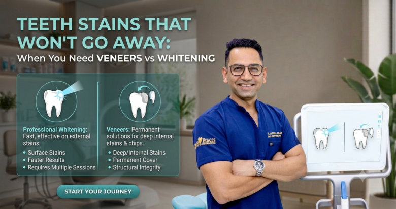 Teeth Stains That Won't Go Away When You Need Veneers vs Whitening